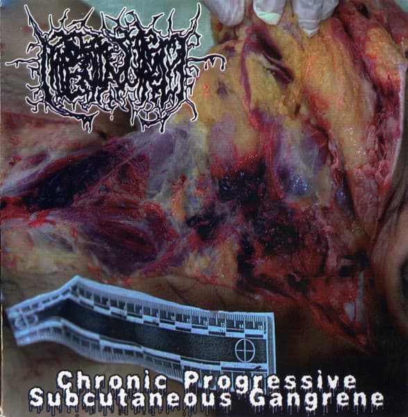 Hipermenorrea, Cannibe, Cannibe, Cannibe, Cannibe, Hipermenorrea, Hipermenorrea, Hipermenorrea, Hipermenorrea, Hipermenorrea — Chronic Progressive Subcutaneous Gangrene / Laboratorio De Anatomia